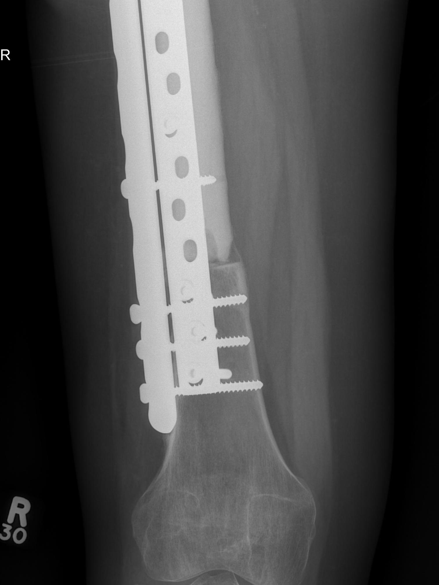 Massive Femoral Allograft0001